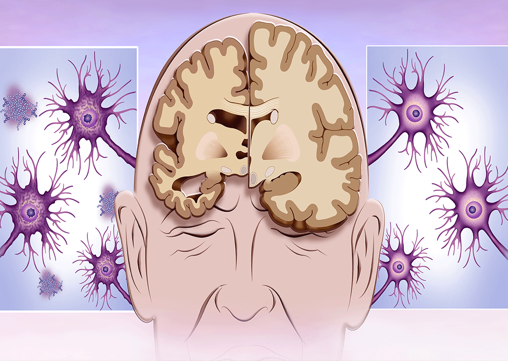 When People With Brain Injuries Think Nothing’s Wrong It’s Anosognosia When People With Brain Injuries Think Nothing’s Wrong It’s Anosognosia
